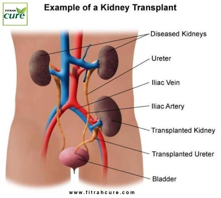 Artificial Kidney Transplant May Possibly Hit The Indian Market by 2020 
